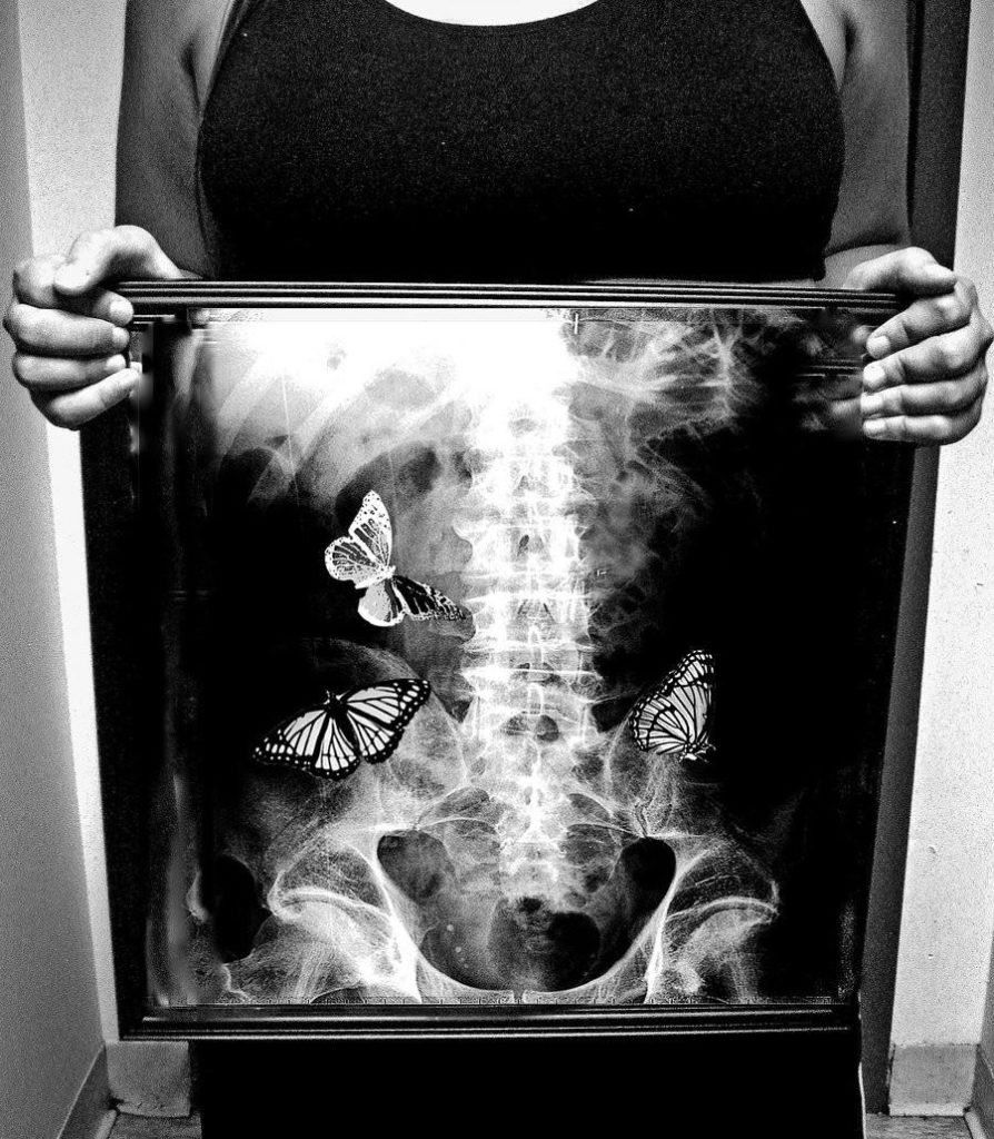 Бабочки в моем животе это любовь. Бабочки в животе. Бабочки в животе рентген. Ревген бабочки в живате. Реньшен бабочки в животе.